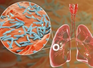 Alerta tuberculosis: se notificaron más de 13.000 casos en Argentina